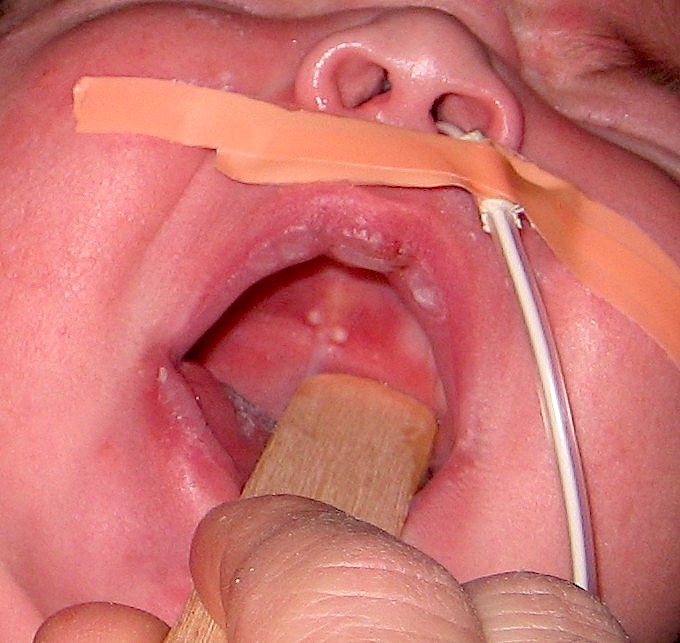 Palatal cyst of the newborn