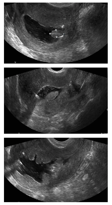 Figure 14: Saline Infusion Sonogram (SIS) showing endometrial polyp