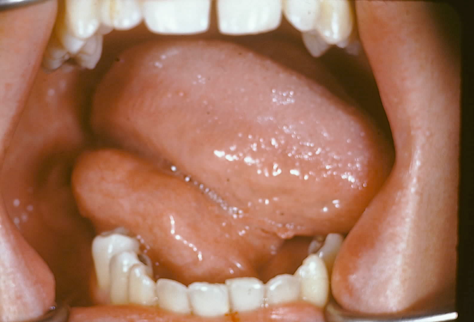 Epidermoid cyst on lateral tongue