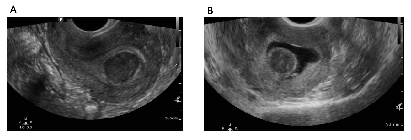 Figure 16: Type 0 submucosal fibroid shown on (A) 2D transvaginal scan and (B) Saline Infusion Sonogram (SIS)