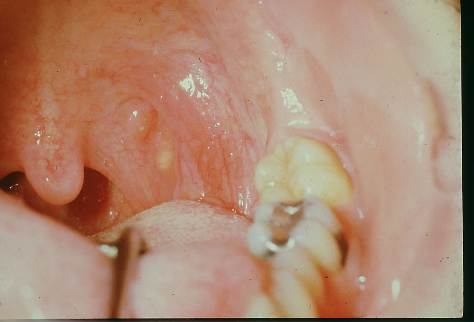 Oral lymph-epithelial cyst and aggregate on posterior pharyngeal pillar