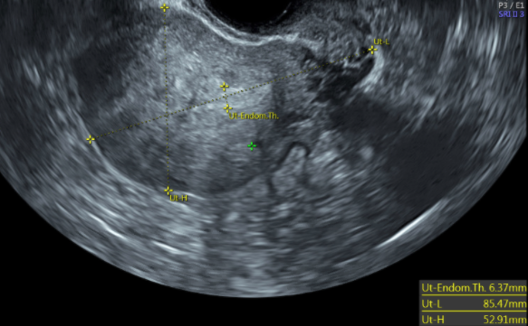 Figure 17: 2D transvaginal scan showing sagittal view of the uterus with adenomyosis