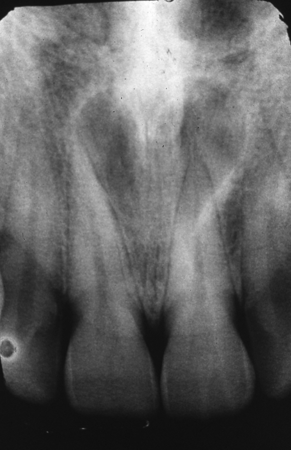 Nasopalatine duct cyst radiograph of anterior maxilla