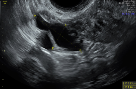 Figure 19: 2D transvaginal ultrasound showing hydrosalpinx