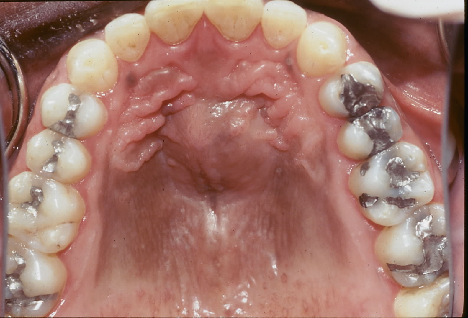 Clinical photograph of nasopalatine duct cyst of anterior maxilla