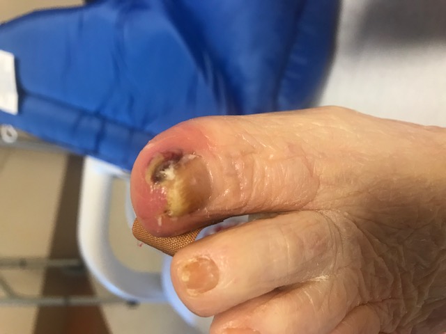 <p>Ingrowing Nail, Medial Border of the Left Hallux