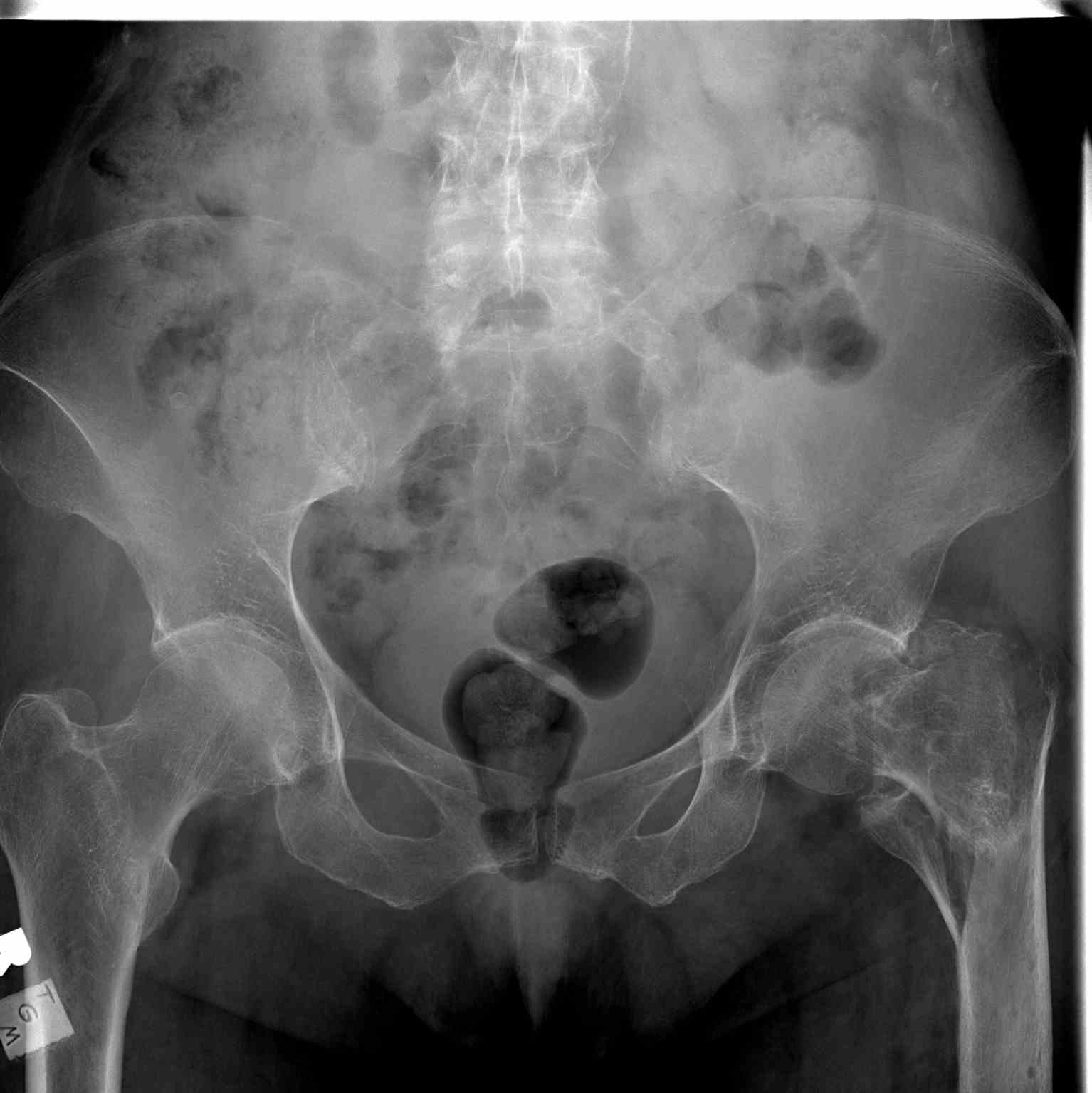 Pelvic Radiograph Left Hip Fracture