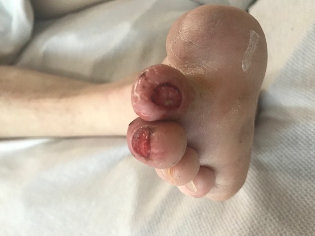 Neuropathic ulcerations in a patient with diabetes. Note the prior hallux amputation 