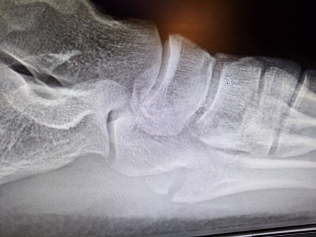 Lateral radiograph demonstrating an avulsion fracture of the fifth metatarsal base