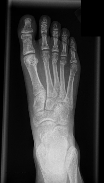 A Right AP (Anteroposterior) Radiograph of a foot.