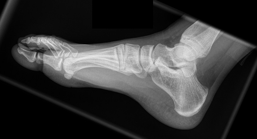 A Right foot Lateral Radiograph.