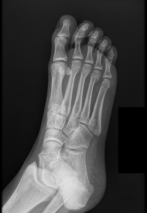 A Right foot oblique radiograph.