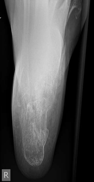 Right foot Radiograph Harris view.  This axial X-ray is used to visualize the calcaneus when evaluating a fracture.