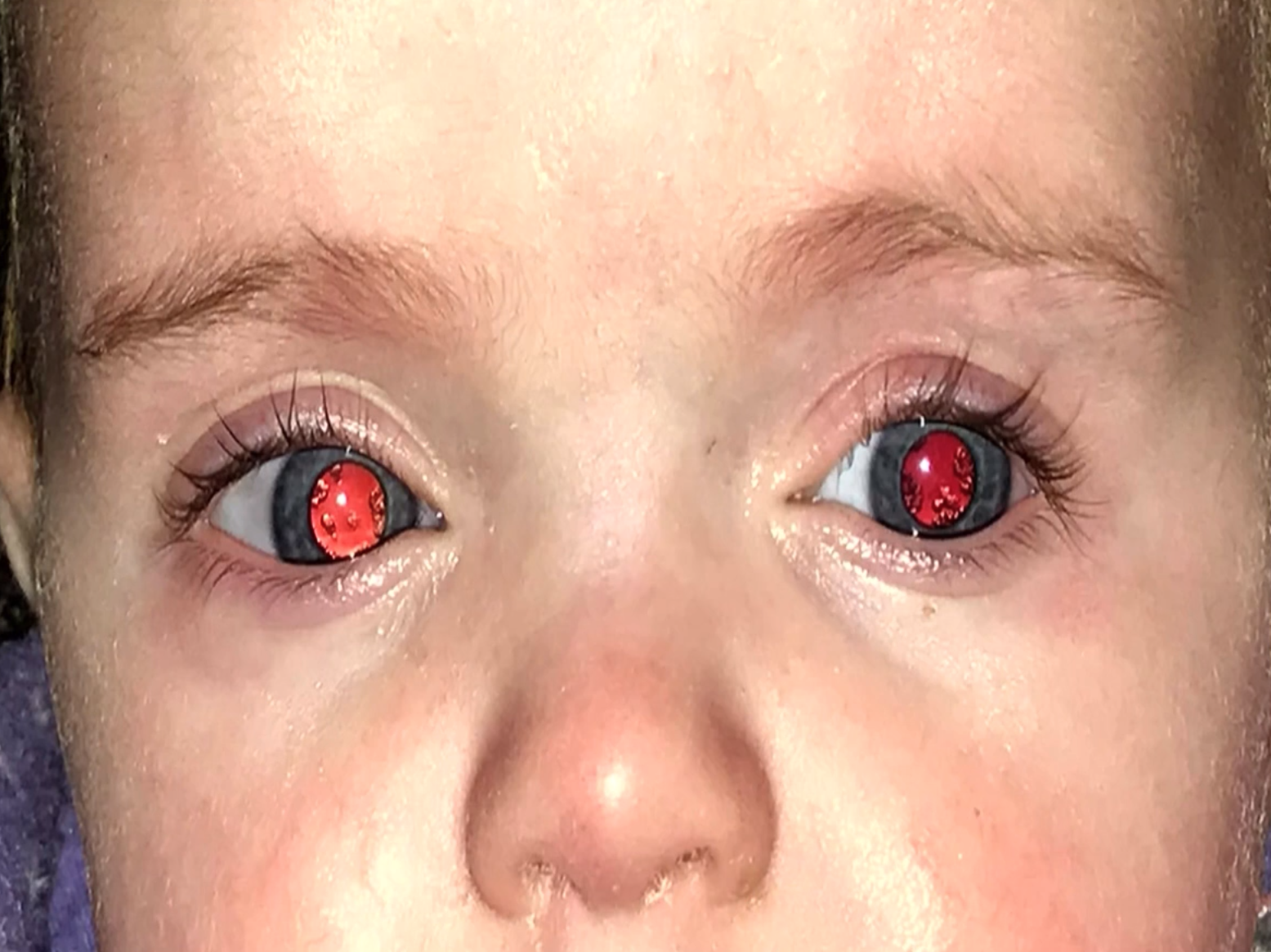 Congenital Cataracts: peripheral lenticular opacities of the type often seen in patients with galactosemia or galactokinase d