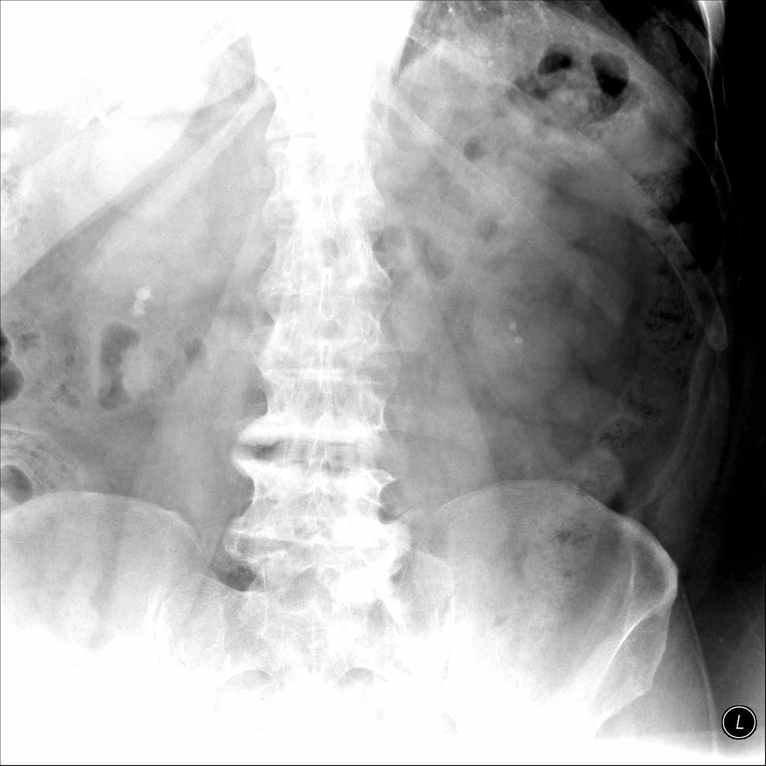<p>Renal Stones on&nbsp;KUB Radiography. This x-ray shows renal calculi in the right and left kidneys.</p>