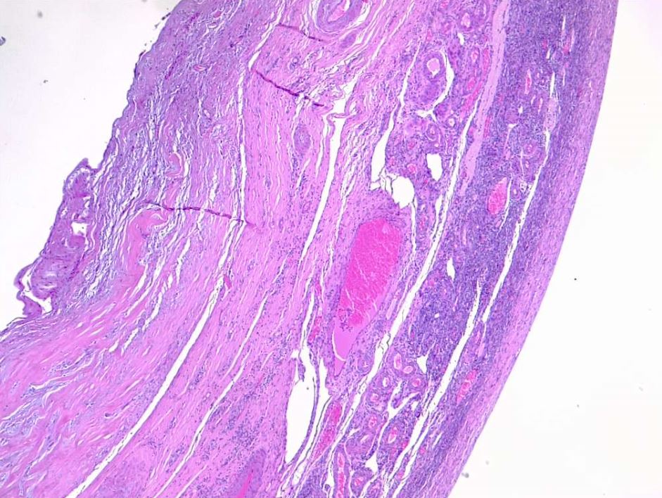 Cystadenofibroma of the ovary