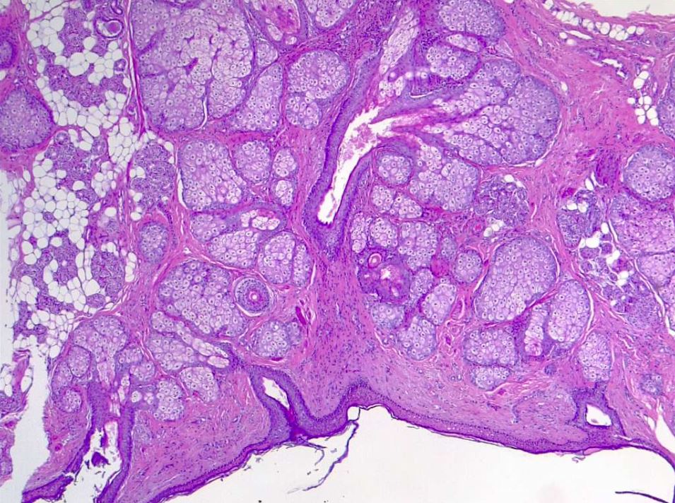 Dermoid cystic teratoma of the ovary.