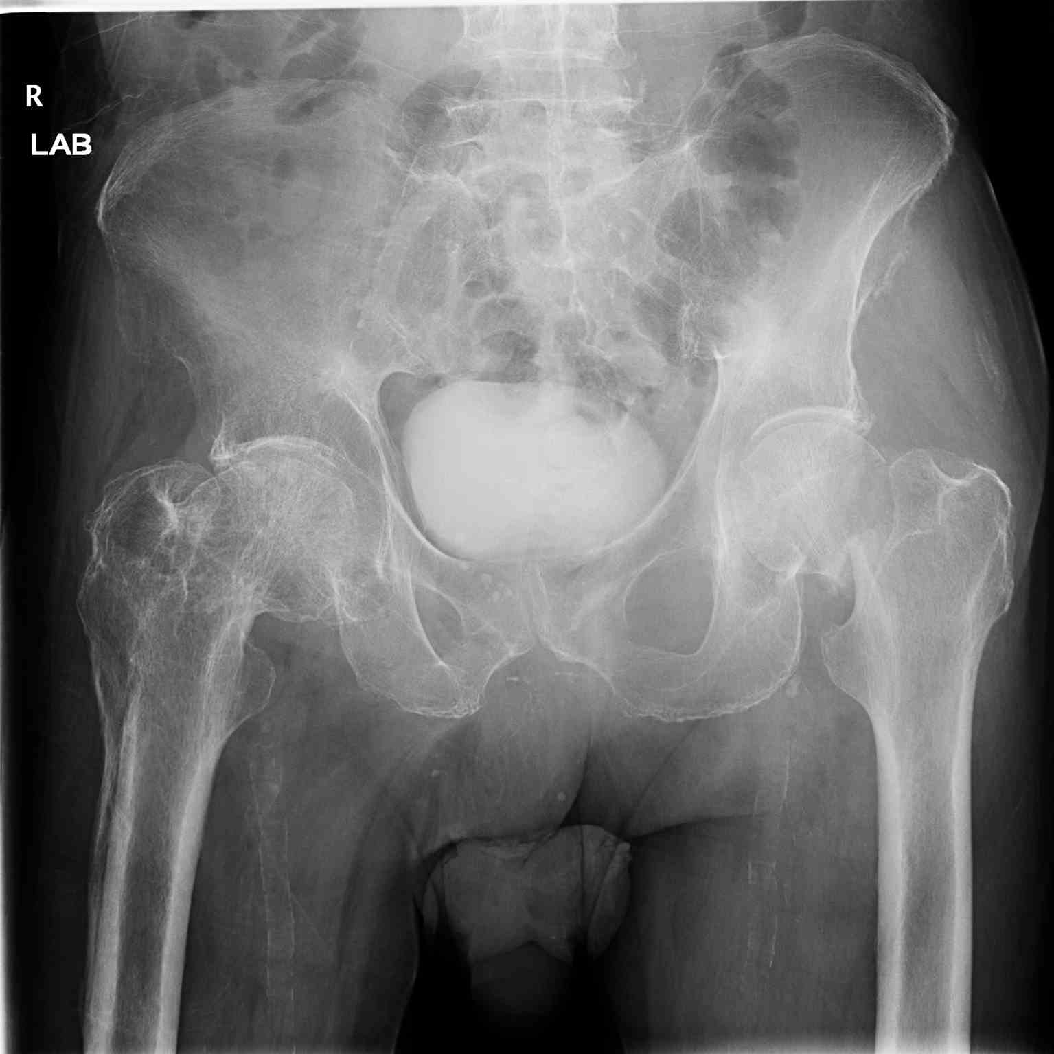 Pelvic Radiograph Right Hip Fracture