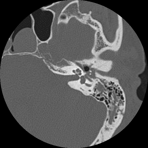 CT Head Temporal Bone Fracture 