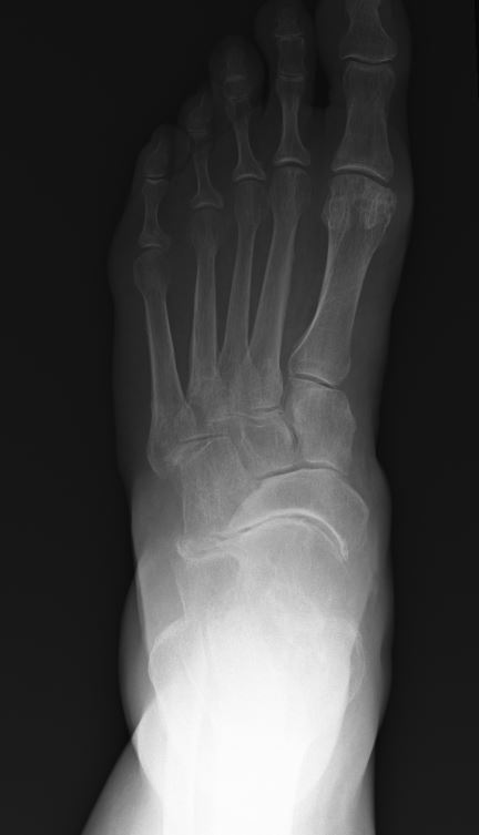 Triple Arthrodesis / Foot Arthritis - Note the severe degenerative changes in the TNJ, CCJ, and STJ requiring fusion of all 3 joints