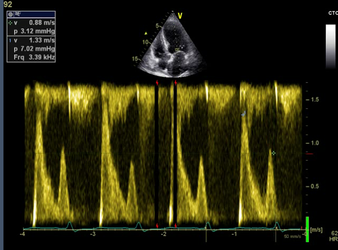 Figure.3
Pulsed wave (PW) Doppler at mitral inflow.