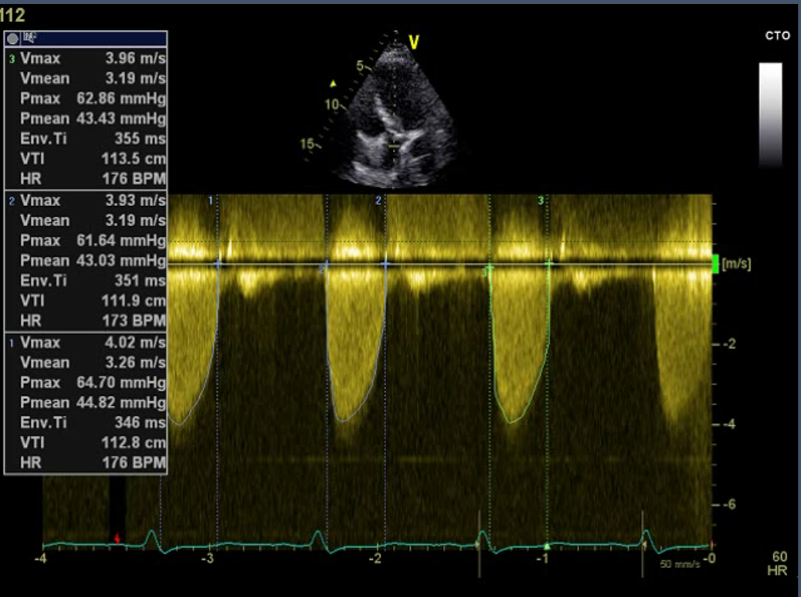 Figure.4
Continuous wave (CW) Doppler at aortic valve