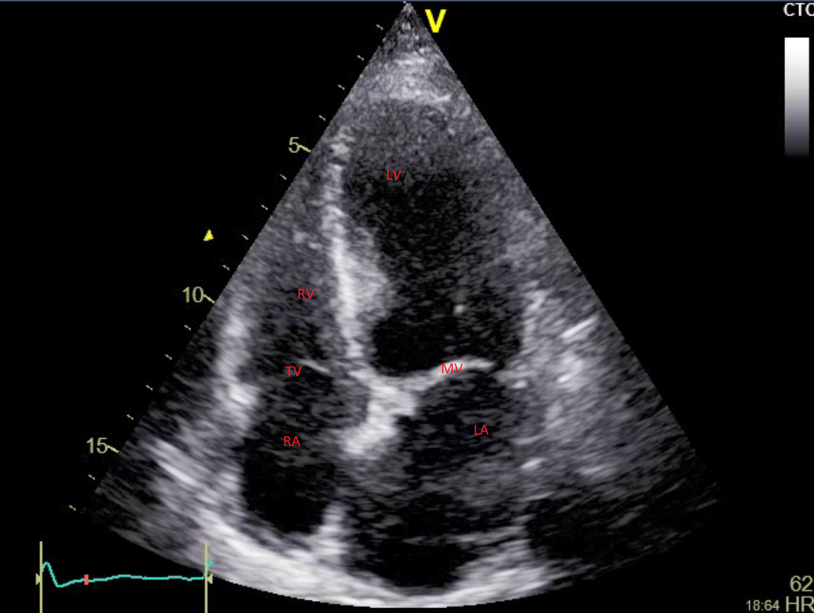 Figure.5
Apical four chamber (A4C) view.
LV= Left ventricle, RV= Right ventricle, LA= Left atrium, RA= Right atrium, MV= Mitral valve, TV= Tricuspid valve