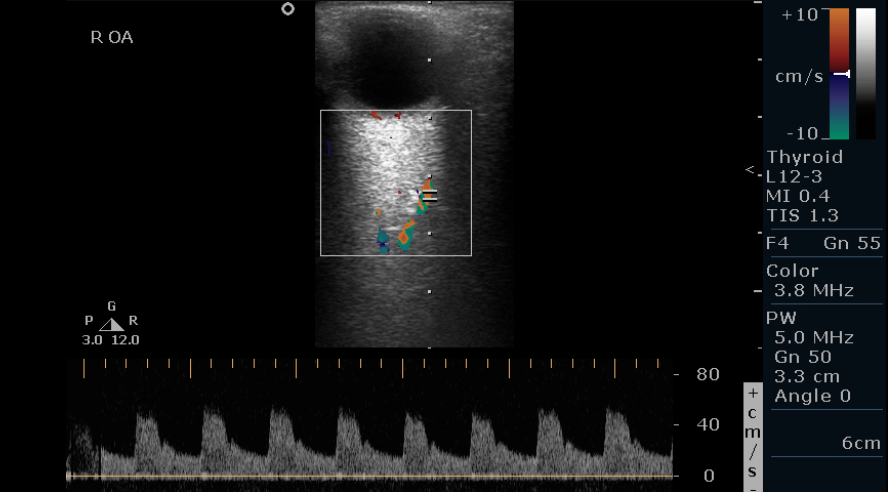 <p>Normal Ophthalmic Artery Doppler of the Right Eye