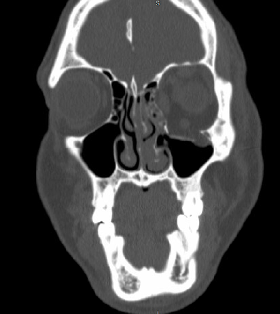 Figure 1. Coronal slice of a computed tomography scan of the maxillofacial bones, demonstrating a fracture of the left orbital floor with herniation of intra-orbital fat into the left maxillary sinus. 