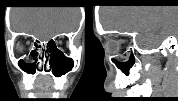 Figure 2. Computed tomography of the maxillofacial bones, demonstrating a right orbital floor fracture with entrapment of the inferior rectus muscle within the maxillary sinus. 