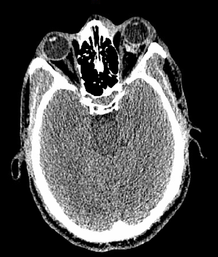 Figure 3. Axial computed tomography of the orbits demonstrating a left retrobulbar hemorrhage associated with left orbital proptosis. 