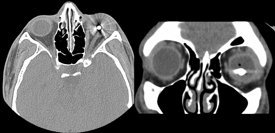 Fig 5. Axial (left) and coronal (right) computed tomography of the orbits demonstrating a metallic intraocular foreign body and the presence of intraocular air in a patient who was struck with a BB pellet.