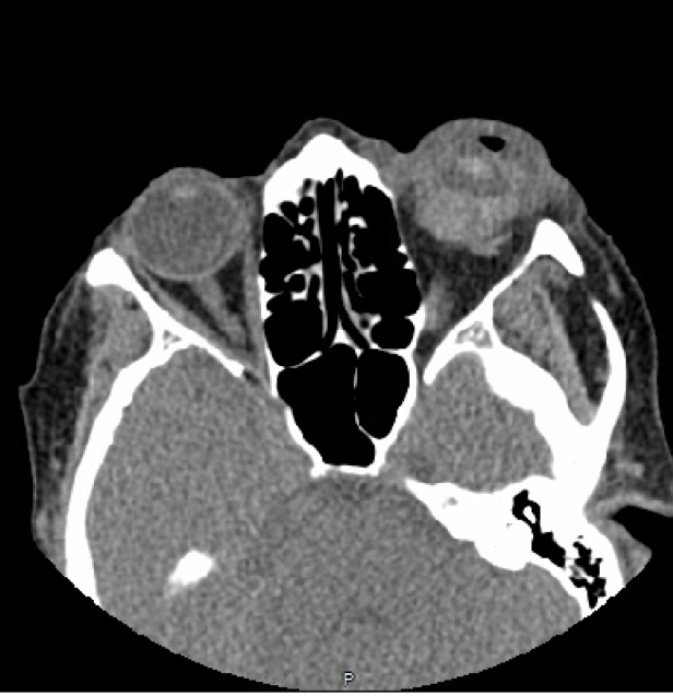 Figure 7. Axial computed tomography of the orbits demonstrating an abnormal left globe contour with extensive soft tissue swelling and fluid consistent with globe rupture. There is dependent hyperattenuation within the left globe consistent with vitreous hemorrhage. 