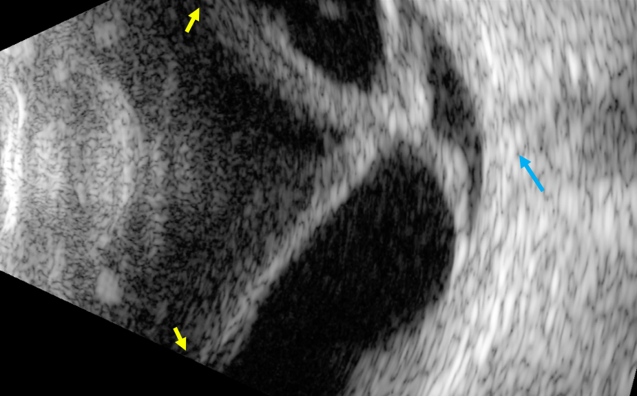 Figure 9. B-scan image of a funnel retinal detachment attached posteriorly at the optic nerve (blue arrow) and anteriorly at the ora serrata (yellow arrows). Dynamic study showed reduced retinal mobility. 