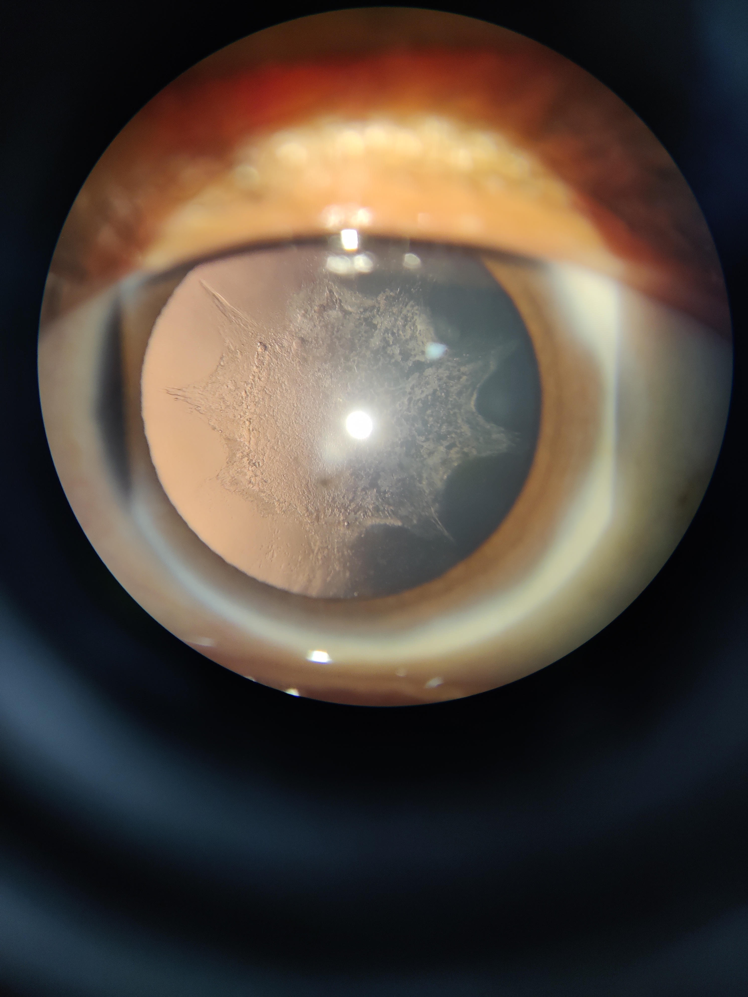 Slit lamp examination under retroillumination of a patient with complicated cataract, reveals diffuse Posterior subcapsular cataract with typical BREADCRUMB appearance.
