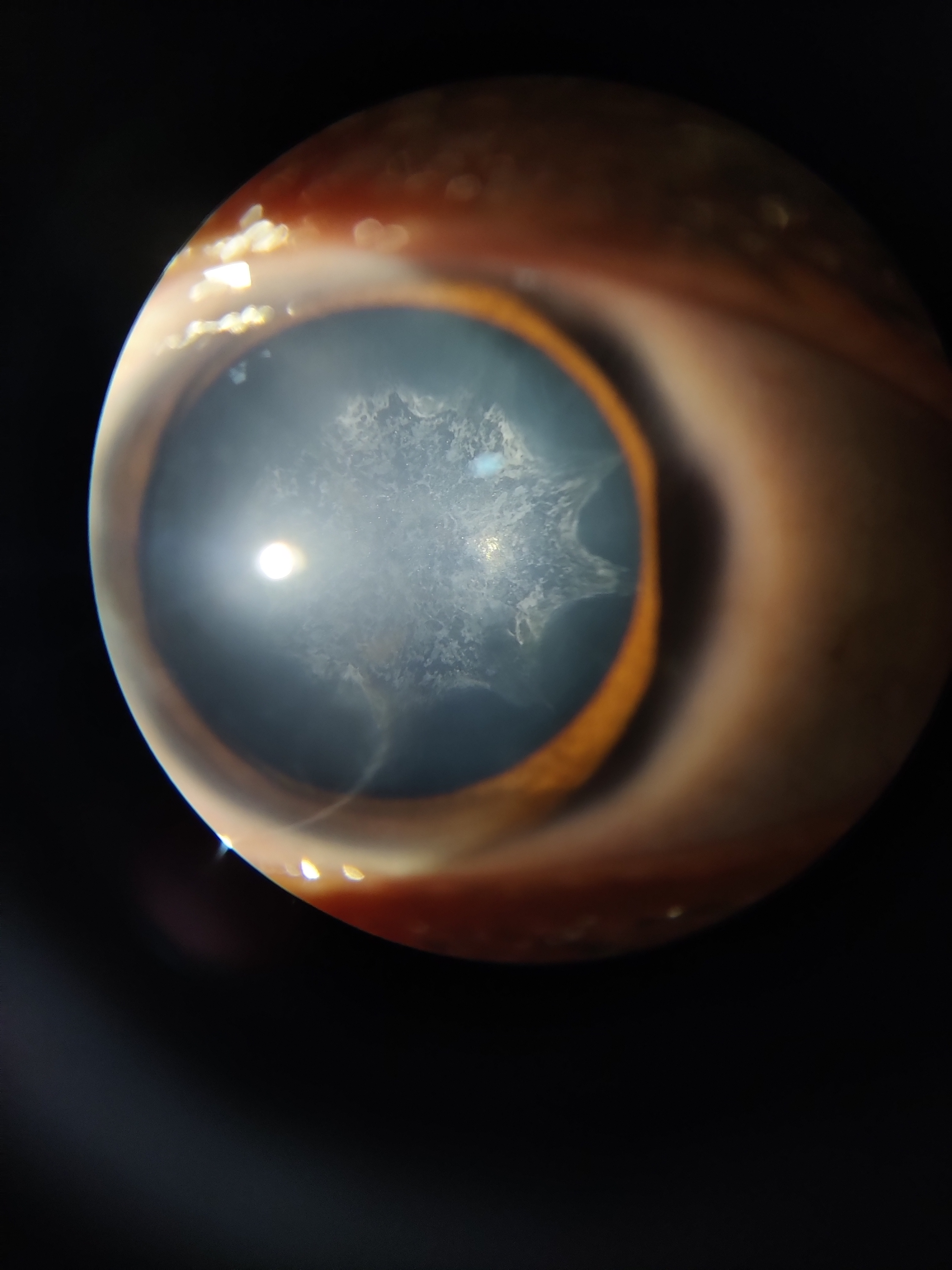 Slit lamp examination under diffuse illumination of a patient with complicated cataract reveals diffuse posterior subcapsular cataract with typical BREADCRUMB appearance and Polychromatic lusture.