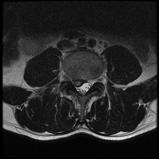 <p>Lumbar Spine MRI, Disc Herniation</p>