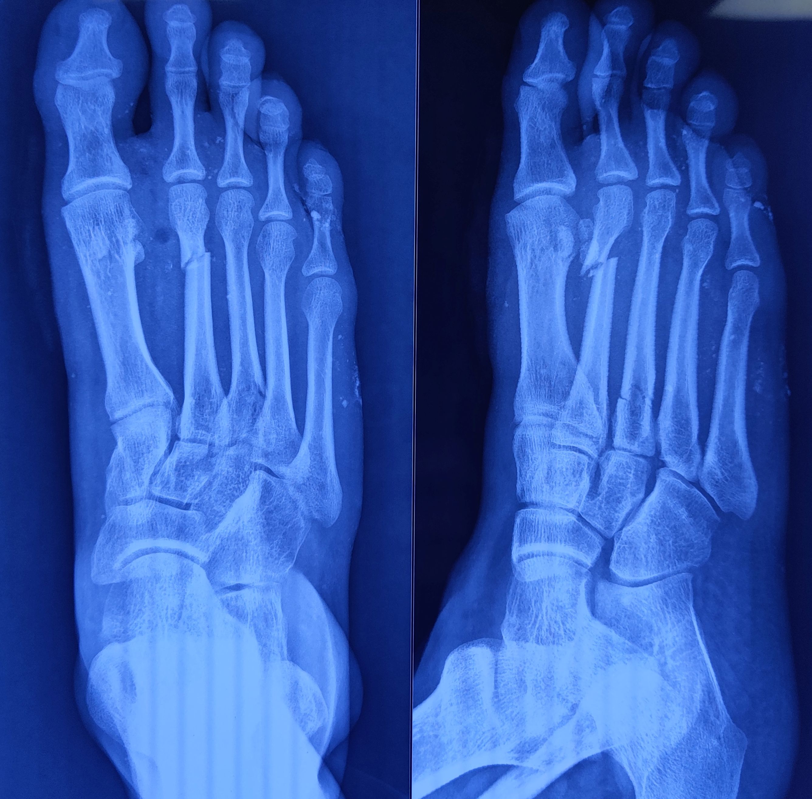 X-ray of right foot anteroposterior and oblique view showing a displaced fracture of distal shaft 2nd metatarsal (>4 mm displacement) and a minimally displaced fracture of proximal shaft 3rd metatarsal.