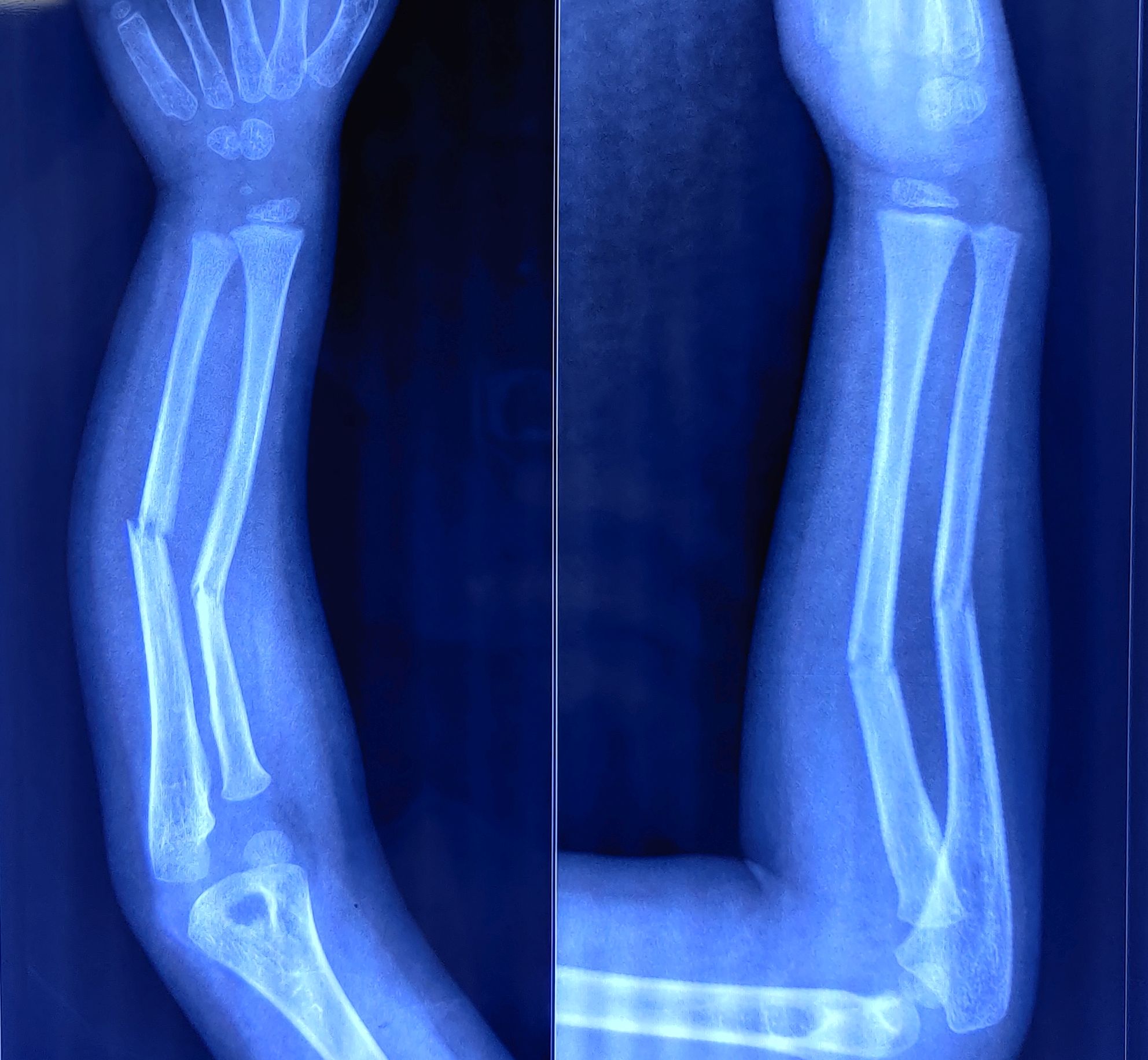 X-ray of right forearm anteroposterior and lateral view in a five-year-old child showing middle-third both bone fracture.