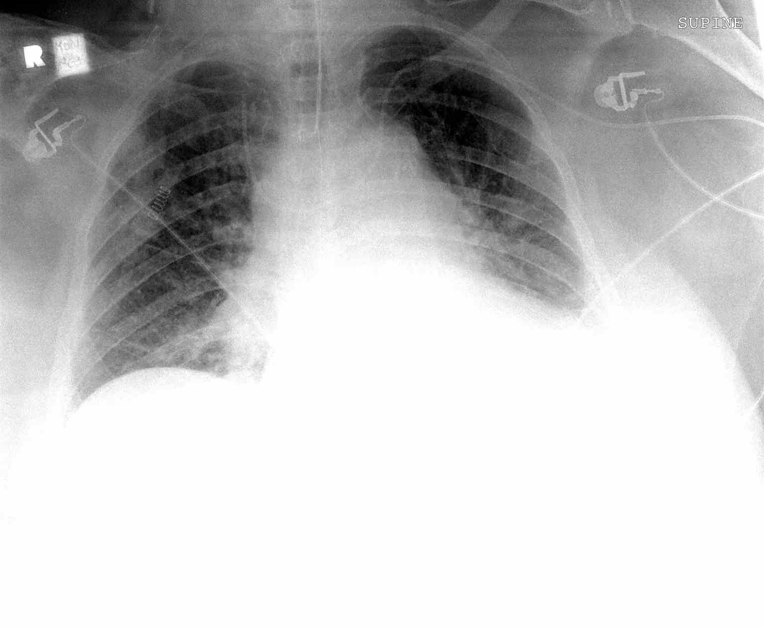 Chest Radiograph Malposition Central line