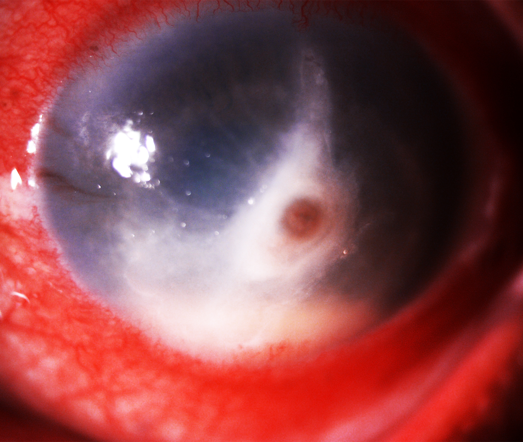 Figure 1-  Slit lamp image depicting conjunctival congestion, 4x3 mm central full thickness infiltrate with corneal perforation, few tentacular projections, inferior limbal spread of infiltrate with anterior chamber hypopyon suggestive of Pythium keratitis