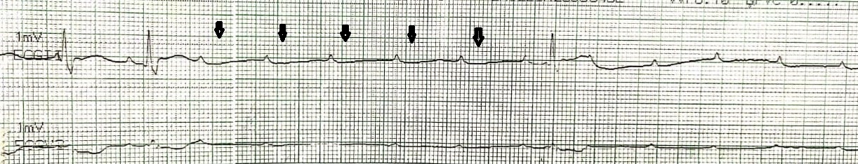 Figure.1: Rhythm strip of  a patient with dual chamber pacemaker programmed as DDD mode. Arrows indicate output failure of ventricular lead resulting in asystole.(Device interrogation confirmed the output failure)