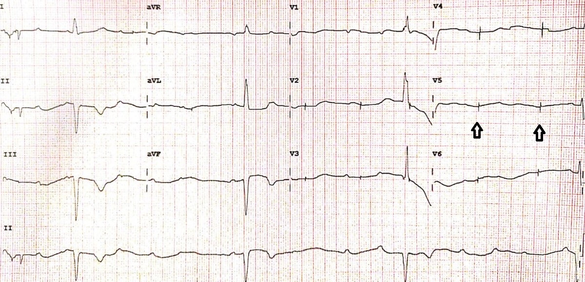 Figure.2: 12 Leads ECG of a patient with dual chamber pacemaker. Arrows indicate pacing spikes without evoke potential. (Failure to capture)