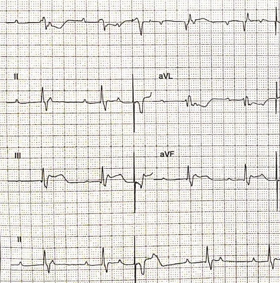 Figure.3: Electrocardiogram of a patient with VVI pacemaker, programmed at a lower rate of 50 beats per minute. Shows under-sensing of 2nd QRS complex.