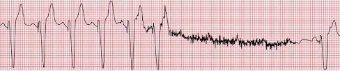 Figure.4: Rhythm strip of a patient with dual chamber pacemaker showing over-sensing and inhibition of pacing.