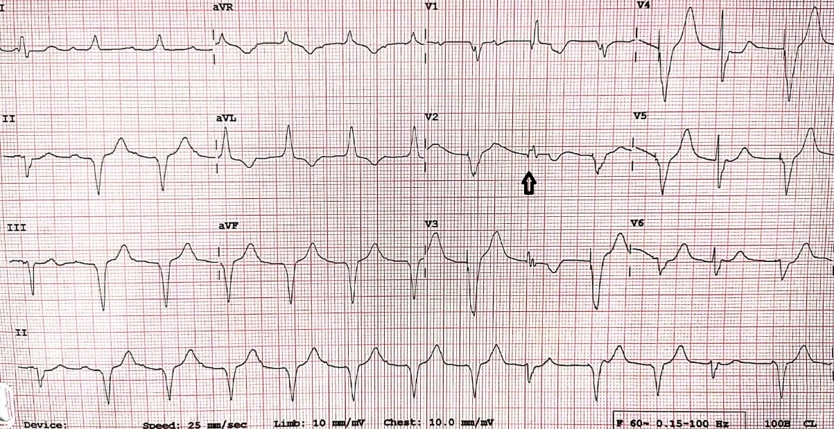 Figure.5: 12 leads ECG of a patient with single chamber pacemaker programmed as VVI. Arrow indicates fusion beat.