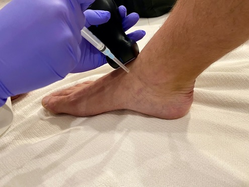 Positioning to perform an ultrasound guided arthrocentesis of the ankle using an out of plane technique. 
* This image does not demonstrate sterile technique as it is only a model of ultrasound / technique positioning.  Sterile technique should always be used for arthrocentesis 
