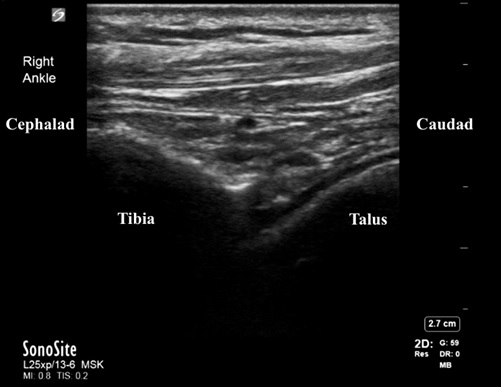 Ultrasound image of a normal ankle.  This is a longitudinal view with the probe marker placed in a cephalad position. The clinician would evaluate for an effusion between the tibia and talus.