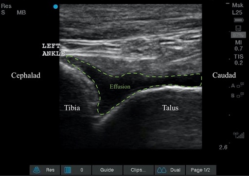 Ultrasound image of an ankle effusion prior to arthrocentesis.  Longitudinal view.  Probe marker cephalad.  An effusion (green dashed line) is noted between the tibia and talus.   From this view an out of plane approach can be utilized for arthrocentesis.