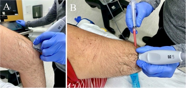 Positioning for ultrasound guided elbow arthrocentesis.  The patient’s arm should be flexed to 90 degrees while the clinician places the probe posteriorly and longitudinally along the joint.  A linear or curvilinear probe can be used.  Ideally the probe should be positioned partially on the proximal ulna at the olecranon.   For uniformity we recommend starting with the probe indicator in a cephalad position (A). To perform an in-plane ultrasound guided arthrocentesis the probe is then rotated 90 degrees while in the same position (B). The needle should then approach in-plane from a lateral position as demonstrated in the image.  
* This image does not demonstrate sterile technique as it is only a model of ultrasound / technique positioning.  Sterile technique should always be used for arthrocentesis 
